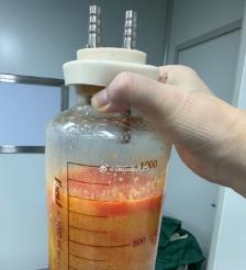 莆田水动力吸脂手术要做多久？